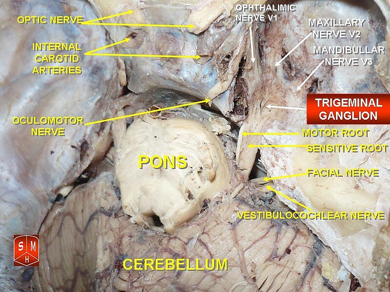 File:Trigeminal ganglion.jpg