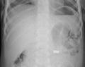 AP X ray showing a 9mm battery in the intestines