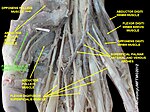 Flexor pollicis brevis muscle