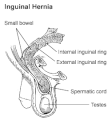 Diagram of an indirect, scrotal inguinal hernia (median view from the left)