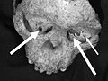 The Taung Child Skull with arrows pointing to Eagle caused damage