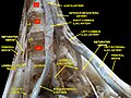 Lumbar and sacral plexus. Deep dissection.Anterior view.