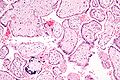 Micrograph of CMV placentitis.