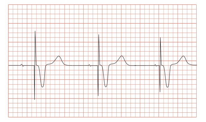 File:ECG pacemaker syndrome.svg