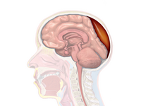 A diagram showing an epidural hematoma.