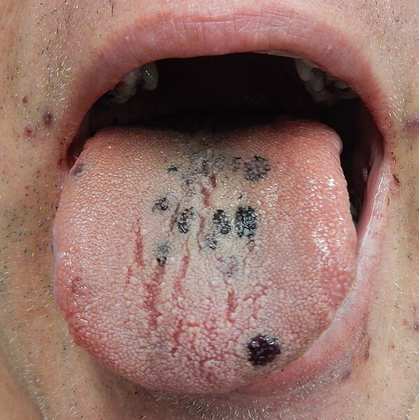 File:Petechia on the tongue.jpg