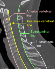 CT scan of normal congruous vertebral lines.[6]