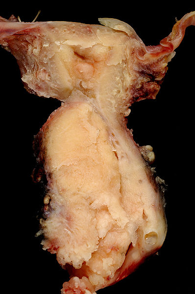 Archivo:Squamous Carcinoma of Cervix.jpg