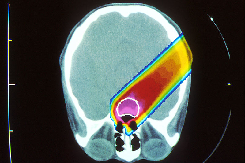 Файл:Proton beam therapy (1).jpg