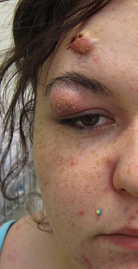 A photograph of a human face with nodular acne