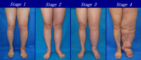 Severity of lower extremity lymphedema in different stages