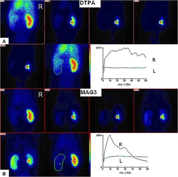 File:99mTc-MAG3 and 99mTc-DTPA renogram.jpg