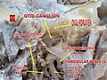 Dissection of otic ganglion