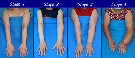 Severity of upper extremity lymphedema in different stages