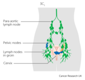 Cervical cancer stage IIIC1