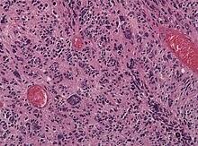 Glioblastoma pleomoprhism HE.jpg