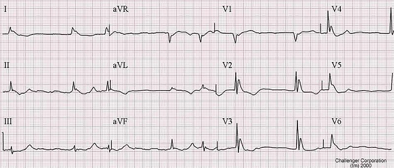 File:HypothermiaECG.jpg