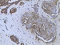 Infiltrating ductal carcinoma of the Breast assayed with anti Mucin 1 antibody