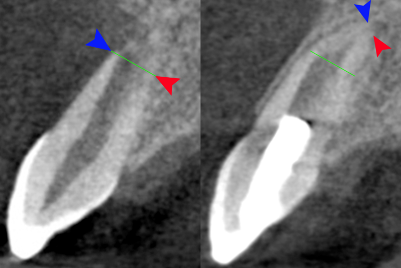 File:Regenerative endodontics.png