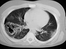 Pulmonary contusion pseudocyst CT.jpg