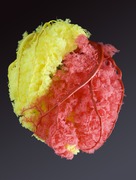 Cast of coronary arteries. Right - yellow, left - red