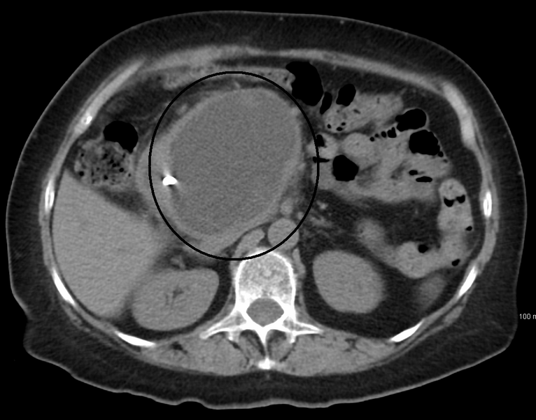 File:Pancreaticpseudocyst.png