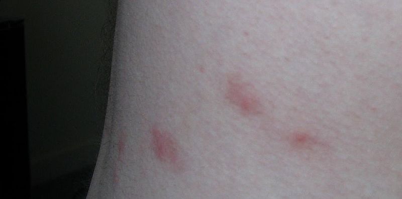 File:Flea bites.jpg