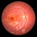 Fundoscopy, right eye of a 5-year-old boy with HJMD