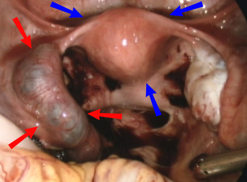 File:Ectopic pregnancy on laparoscopy.png