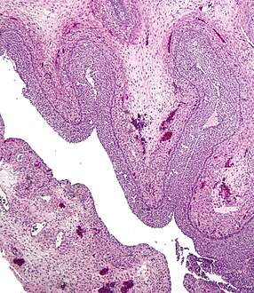 Luteinized follicular cyst. H&E stain.