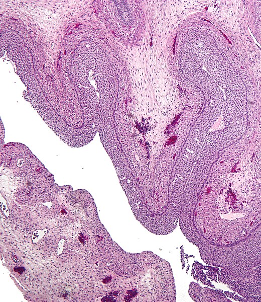 File:Luteinized follicular cyst.jpg