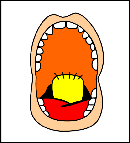 File:Pharyngeal flap procedures4.gif