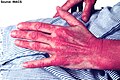 Linear extensor erythema. Confluent erythema of the skin overlying the interphalangeal and extensor tendons of the hand, with extension to the forearm in a patient with dermatomyositis