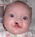 6 month old girl before going into surgery to have her unilateral incomplete cleft lip repaired.