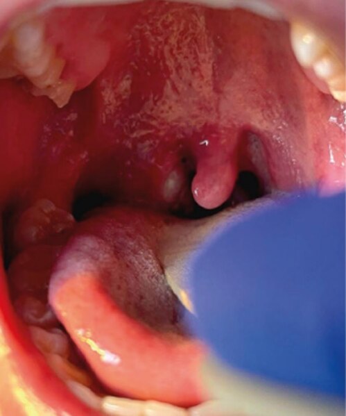 File:Oral monkeypox lesion.jpg