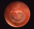 Otitis media acuta