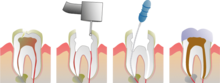 Root Canal Illustration Molar.png