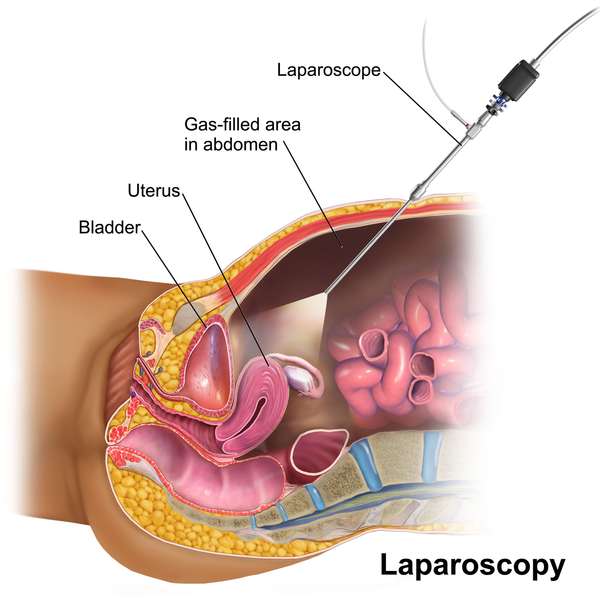 File:Blausen 0602 Laparoscopy 02.png