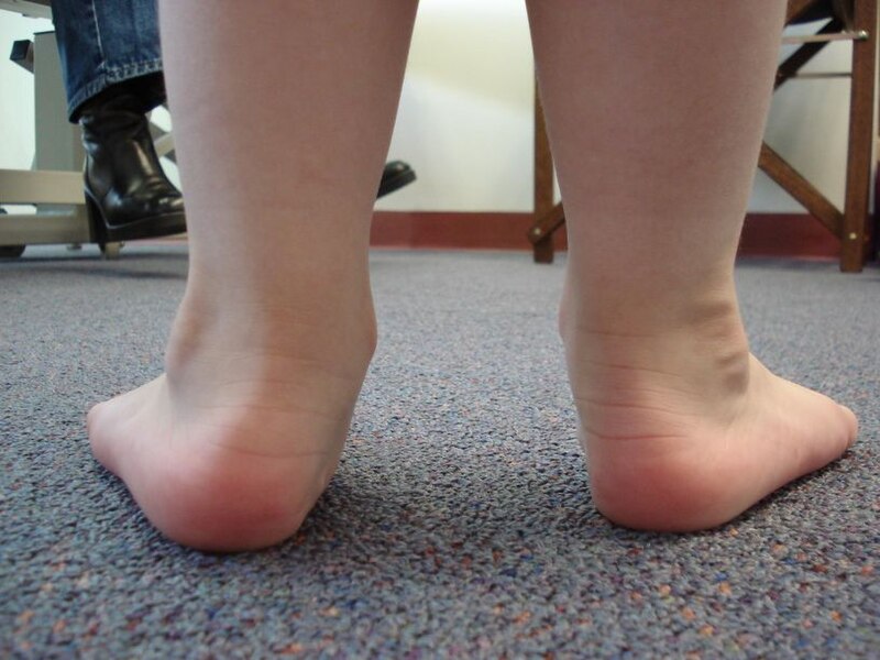 File:Children flatfeet.jpg