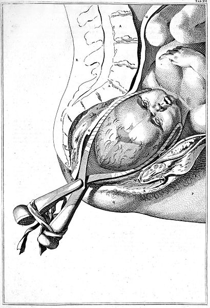 Файл:Smellie forceps.jpg