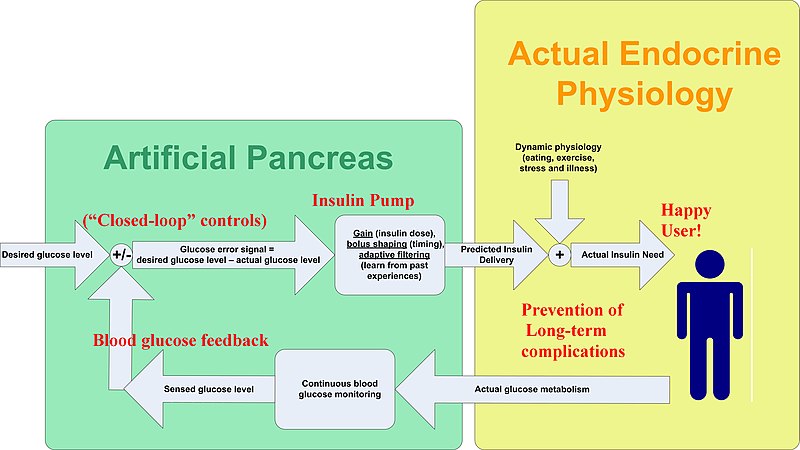 File:Artificial Pancreas.jpg