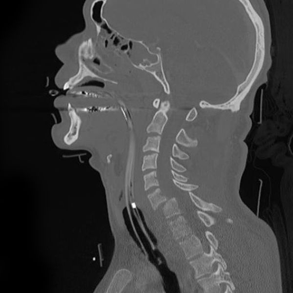 File:Cervical fracture dislocation C6-C7.jpeg