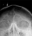 A part of X-ray investigation of frontal bone sinuses.