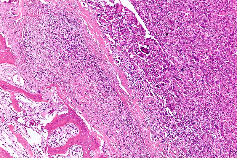 File:Osteosarcoma - intermed mag.jpg