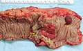 Gross appearance of a colectomy specimen containing two adenomatous polyps (the brownish oval tumors above the labels, attached to the normal beige lining by a stalk) and one invasive colorectal carcinoma (the crater-like, reddish, irregularly shaped tumor located above the label)