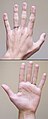 A normal human hand has four fingers and a thumb