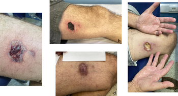 Four images depicting a mans after a spider bite. Images a, b and c show progressing necrosis. Image d shows a residual scar.