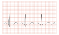 en:Tachycardia