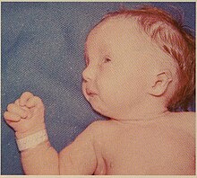 Trisomy 17-18 2.jpg