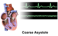 Asystole coarse